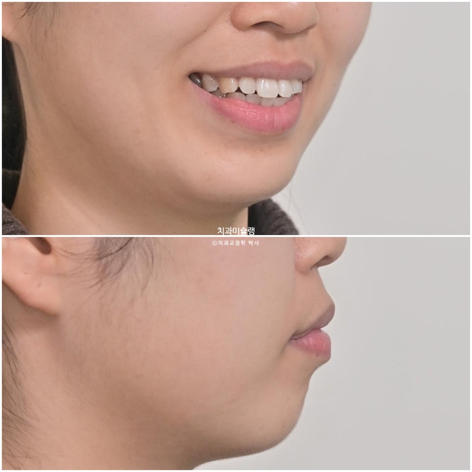 돌출 덧니 반대교합 비발치 인비절라인 라이트 치료기간 10개월 재제작 1회 어금니 교합 뜰때 치료방법