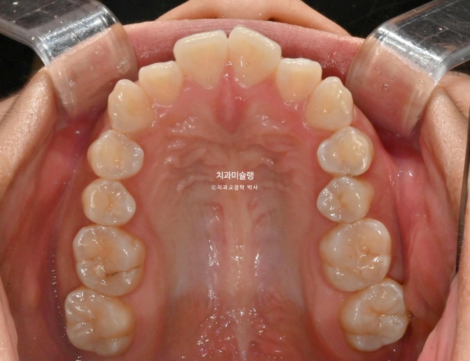 돌출 덧니 반대교합 비발치 인비절라인 라이트 치료기간 10개월 재제작 1회 어금니 교합 뜰때 치료방법