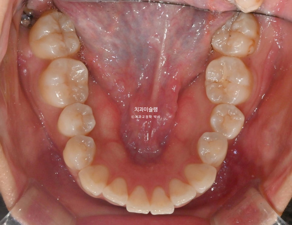 돌출 덧니 반대교합 비발치 인비절라인 라이트 치료기간 10개월 재제작 1회 어금니 교합 뜰때 치료방법