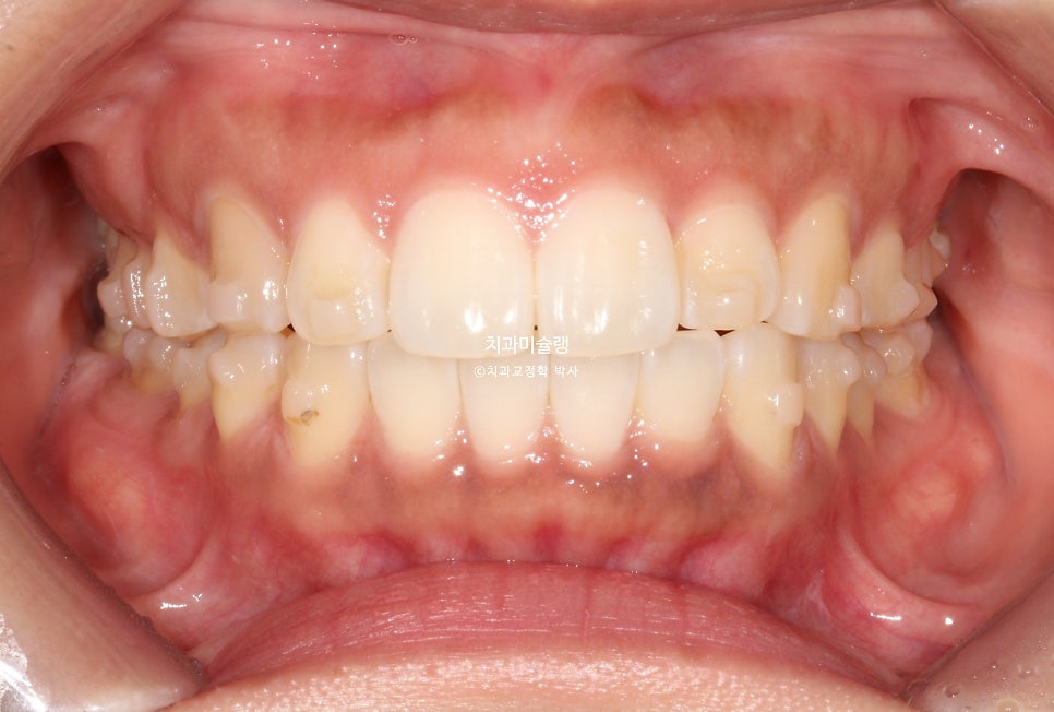돌출 덧니 반대교합 비발치 인비절라인 라이트 치료기간 10개월 재제작 1회 어금니 교합 뜰때 치료방법