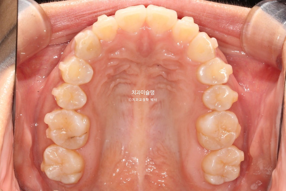 돌출 덧니 반대교합 비발치 인비절라인 라이트 치료기간 10개월 재제작 1회 어금니 교합 뜰때 치료방법