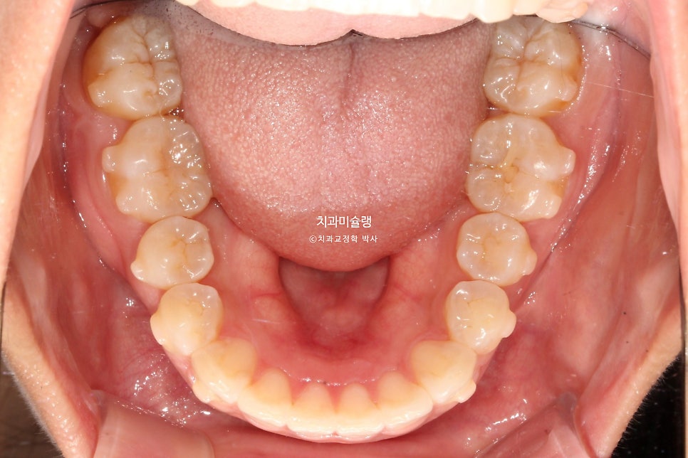 돌출 덧니 반대교합 비발치 인비절라인 라이트 치료기간 10개월 재제작 1회 어금니 교합 뜰때 치료방법