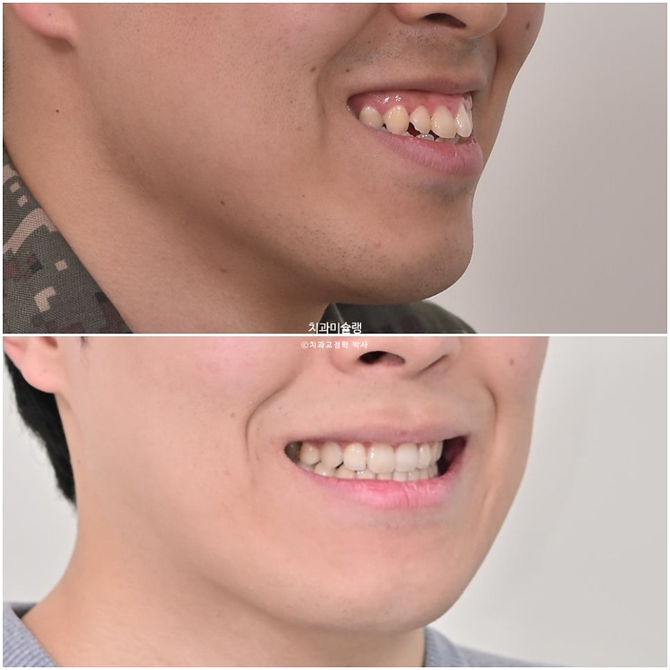 돌출입 잇몸미소 발치 교정 군인 인비절라인 반대교합 덧니 중심선 거미스마일 치료 기간 1년11개월 재제작 1회