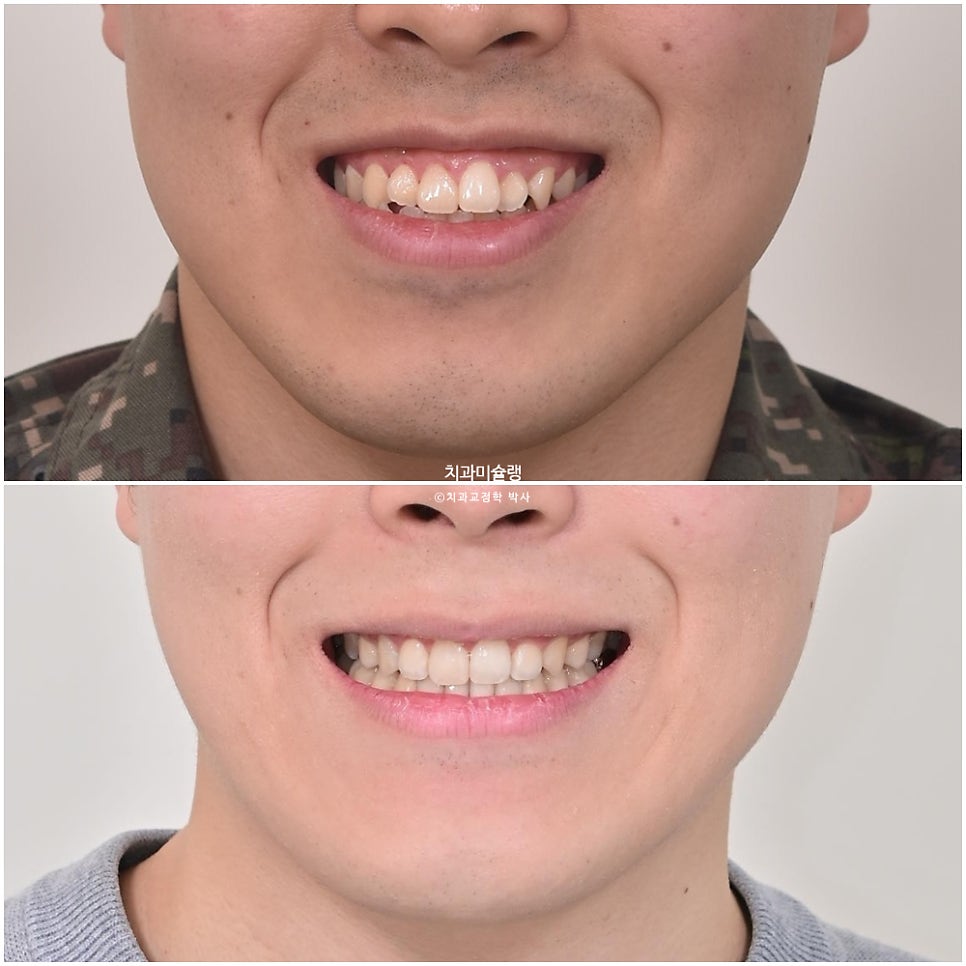 돌출입 잇몸미소 발치 교정 군인 인비절라인 반대교합 덧니 중심선 거미스마일 치료 기간 1년11개월 재제작 1회