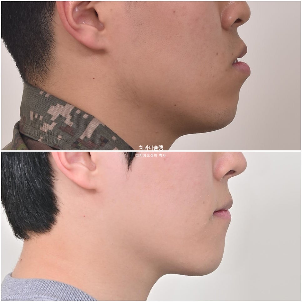 돌출입 잇몸미소 발치 교정 군인 인비절라인 반대교합 덧니 중심선 거미스마일 치료 기간 1년11개월 재제작 1회