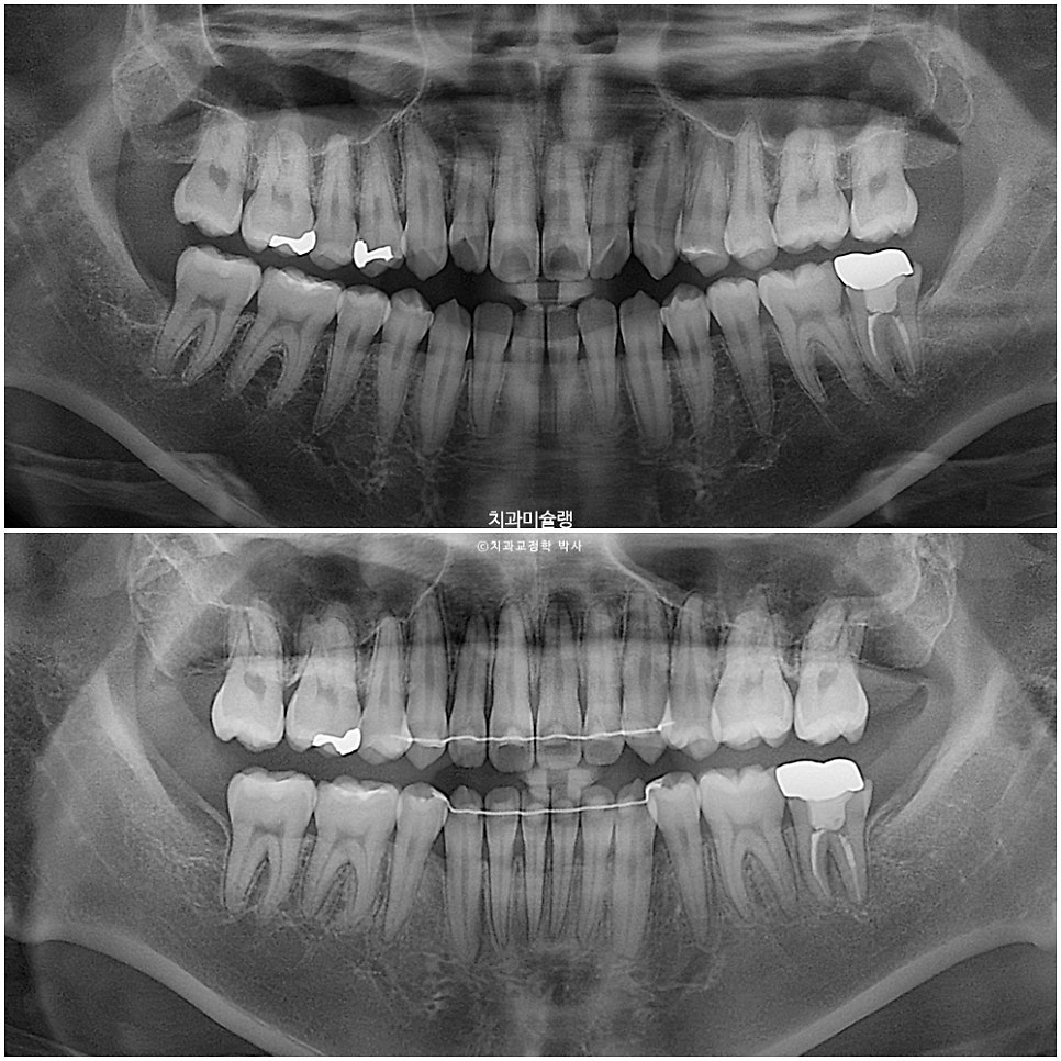 돌출입 잇몸미소 발치 교정 군인 인비절라인 반대교합 덧니 중심선 거미스마일 치료 기간 1년11개월 재제작 1회