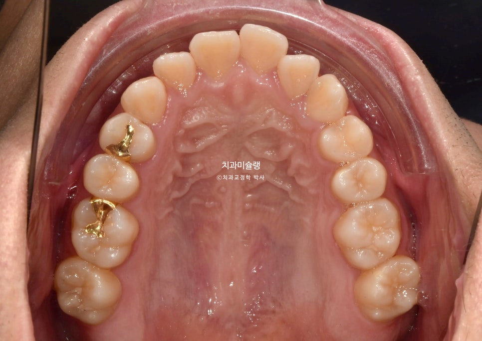 돌출입 잇몸미소 발치 교정 군인 인비절라인 반대교합 덧니 중심선 거미스마일 치료 기간 1년11개월 재제작 1회