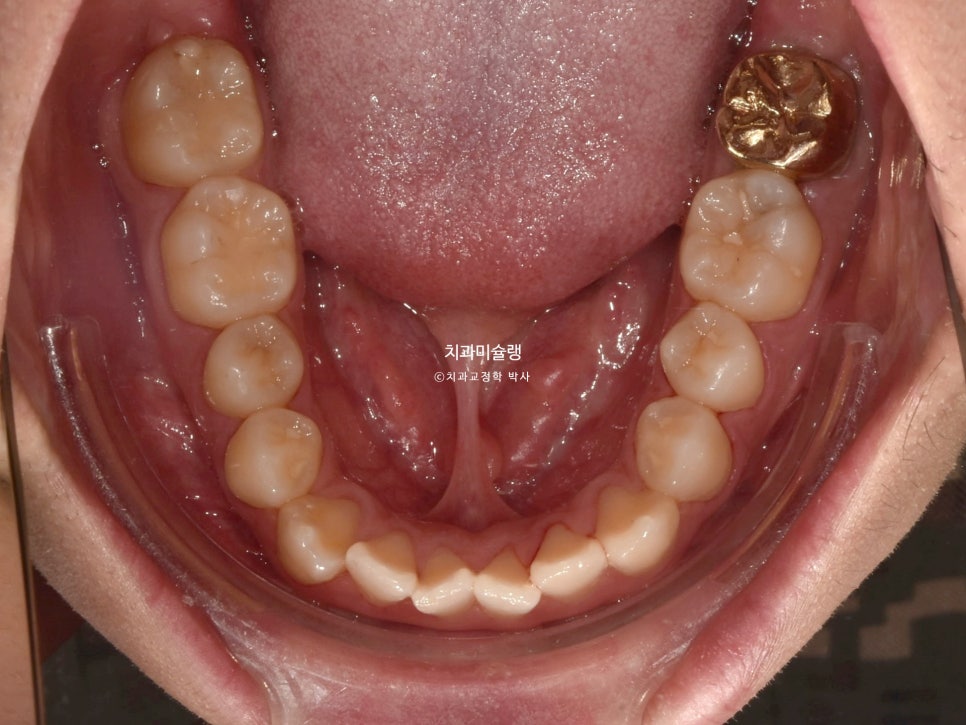 돌출입 잇몸미소 발치 교정 군인 인비절라인 반대교합 덧니 중심선 거미스마일 치료 기간 1년11개월 재제작 1회