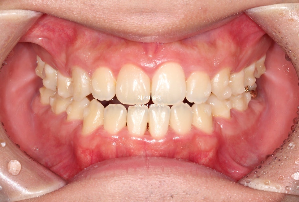 돌출입 잇몸미소 발치 교정 군인 인비절라인 반대교합 덧니 중심선 거미스마일 치료 기간 1년11개월 재제작 1회