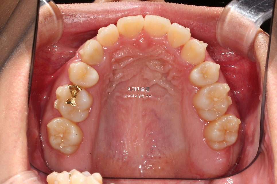 돌출입 잇몸미소 발치 교정 군인 인비절라인 반대교합 덧니 중심선 거미스마일 치료 기간 1년11개월 재제작 1회