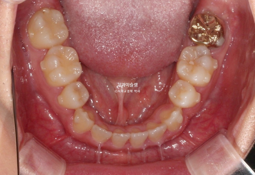 돌출입 잇몸미소 발치 교정 군인 인비절라인 반대교합 덧니 중심선 거미스마일 치료 기간 1년11개월 재제작 1회