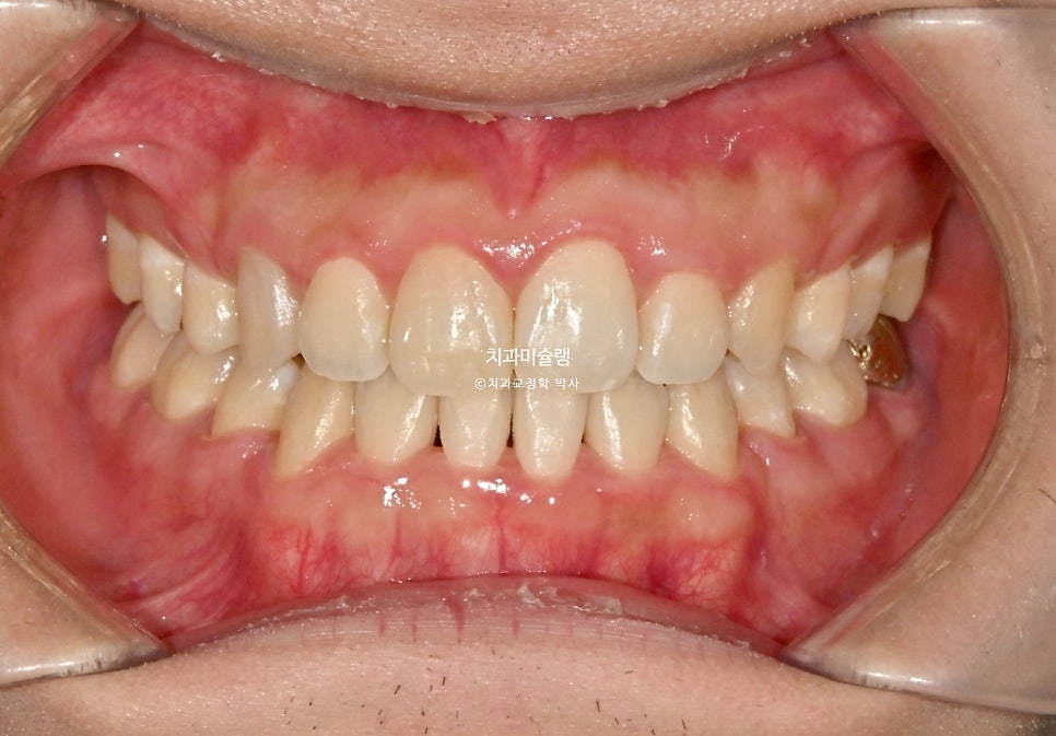 돌출입 잇몸미소 발치 교정 군인 인비절라인 반대교합 덧니 중심선 거미스마일 치료 기간 1년11개월 재제작 1회