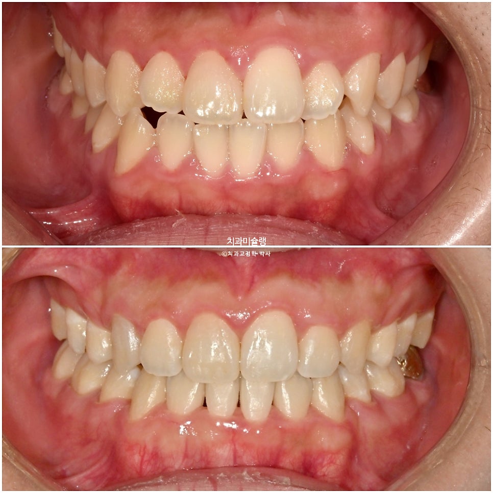 돌출입 잇몸미소 발치 교정 군인 인비절라인 반대교합 덧니 중심선 거미스마일 치료 기간 1년11개월 재제작 1회