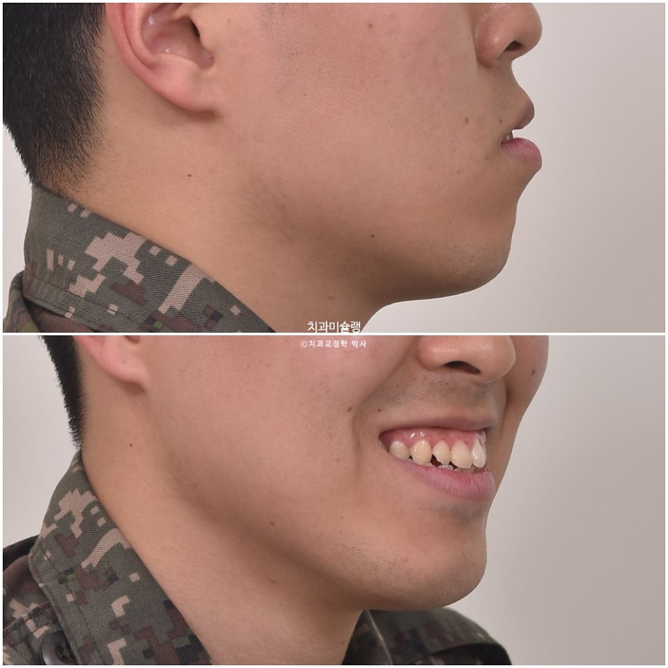 돌출입 발치 인비절라인 군인 교정 덧니 반대교합  거미스마일 잇몸미소 치료기간 1년 11개월 재제작 1회