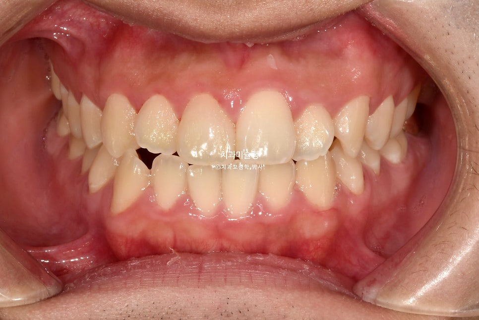 돌출입 발치 인비절라인 군인 교정 덧니 반대교합  거미스마일 잇몸미소 치료기간 1년 11개월 재제작 1회