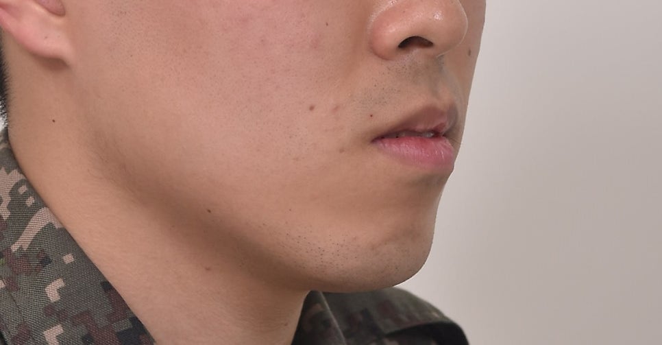 돌출입 발치 인비절라인 군인 교정 덧니 반대교합  거미스마일 잇몸미소 치료기간 1년 11개월 재제작 1회