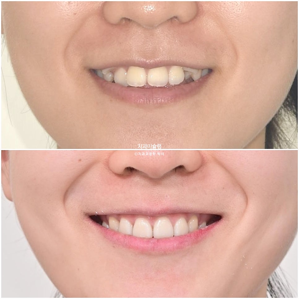 개방교합 덧니 인비절라인 발치 교정 얇은 입술 입매 변화 최소화 교정 치료기간 2년 5개월 재제작 3회