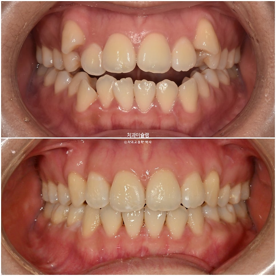 개방교합 덧니 인비절라인 발치 교정 얇은 입술 입매 변화 최소화 교정 치료기간 2년 5개월 재제작 3회