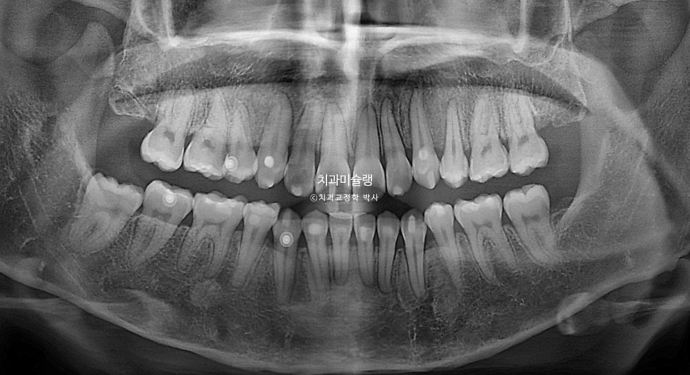 개방교합 덧니 인비절라인 발치 교정 얇은 입술 입매 변화 최소화 교정 치료기간 2년 5개월 재제작 3회