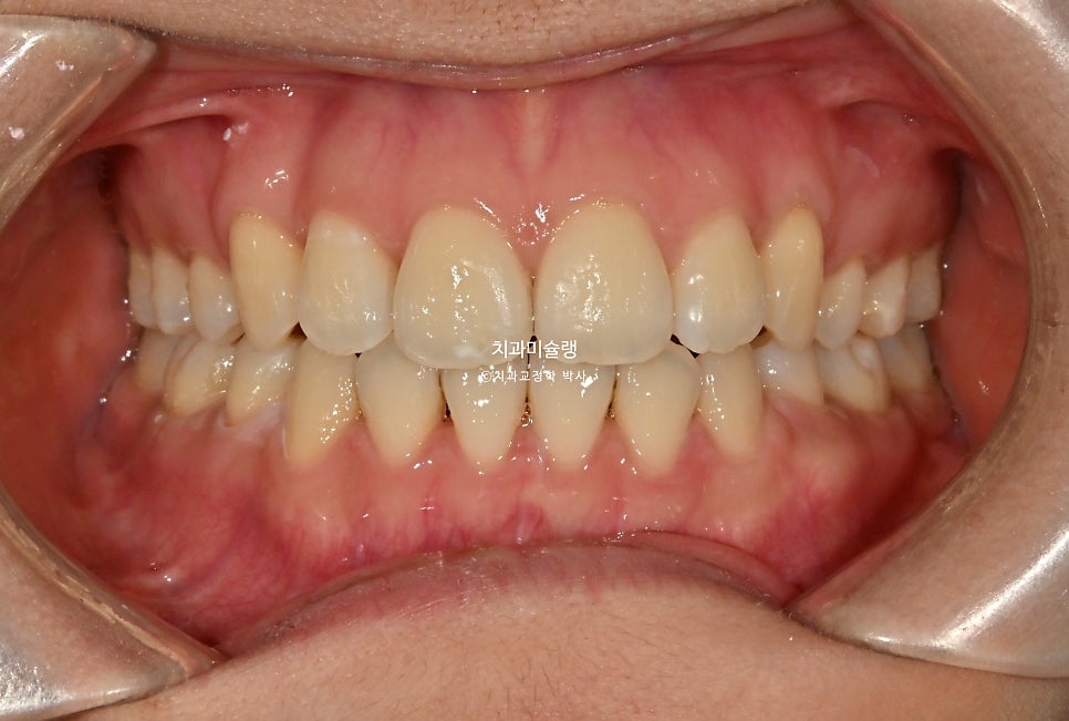 개방교합 덧니 인비절라인 발치 교정 얇은 입술 입매 변화 최소화 교정 치료기간 2년 5개월 재제작 3회