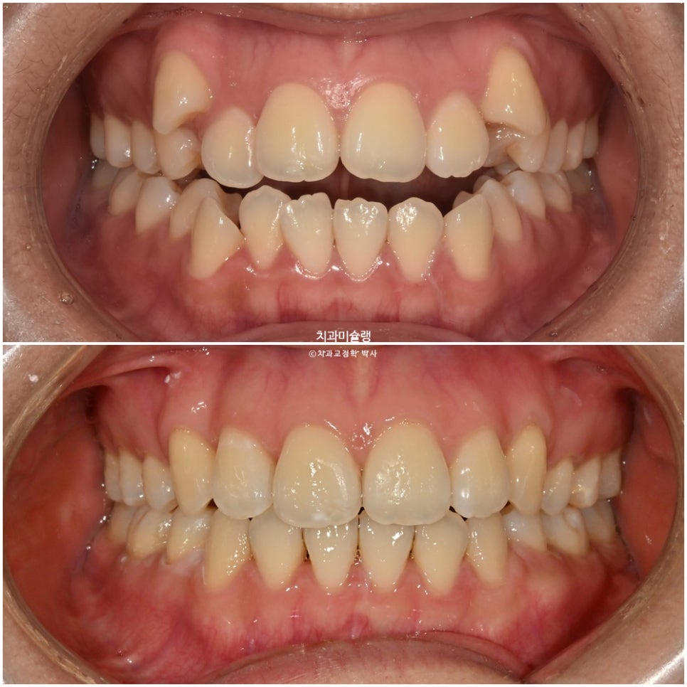 개방교합 덧니 인비절라인 발치 교정 얇은 입술 입매 변화 최소화 교정 치료기간 2년 5개월 재제작 3회