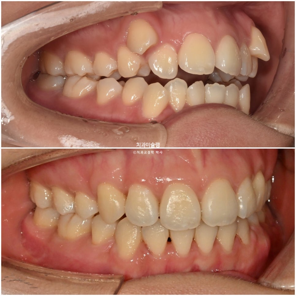 개방교합 덧니 인비절라인 발치 교정 얇은 입술 입매 변화 최소화 교정 치료기간 2년 5개월 재제작 3회
