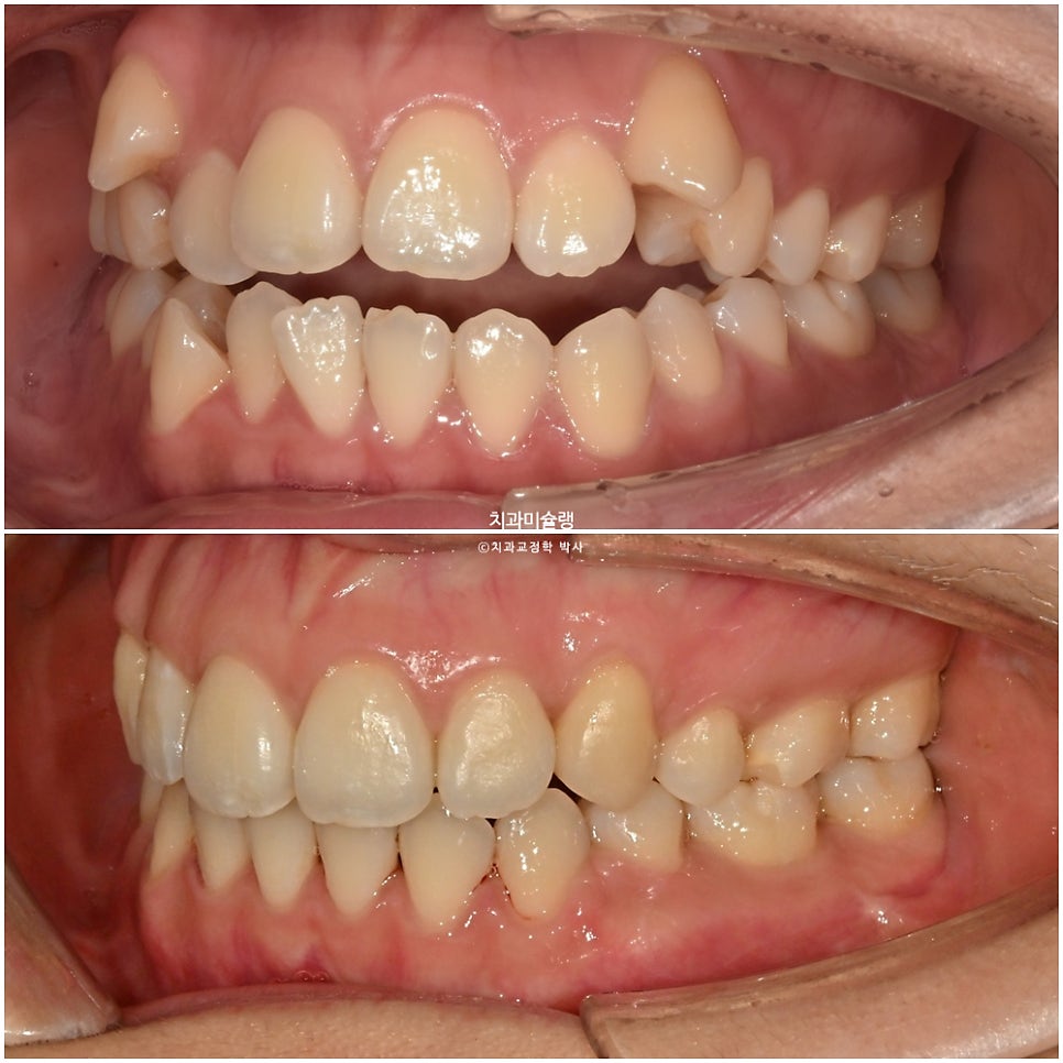 개방교합 덧니 인비절라인 발치 교정 얇은 입술 입매 변화 최소화 교정 치료기간 2년 5개월 재제작 3회