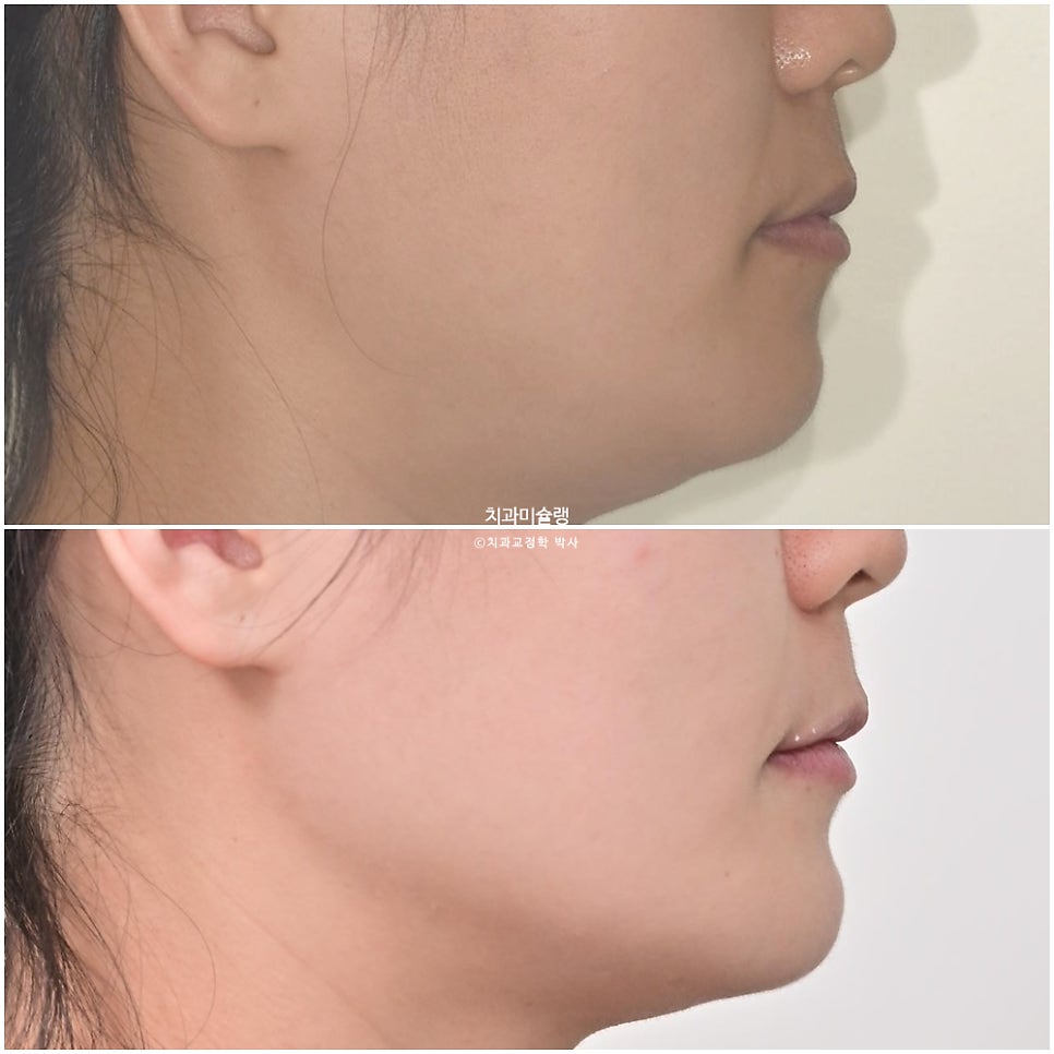 개방교합 덧니 인비절라인 발치 교정 얇은 입술 입매 변화 최소화 교정 치료기간 2년 5개월 재제작 3회