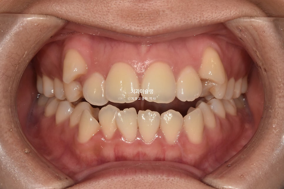 개방교합 덧니 인비절라인 발치 교정 얇은 입술 입매 변화 최소화 교정 치료기간 2년 5개월 재제작 3회