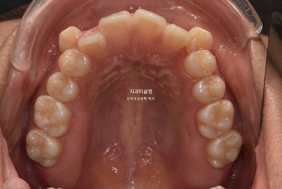 개방교합 덧니 인비절라인 발치 교정 얇은 입술 입매 변화 최소화 교정 치료기간 2년 5개월 재제작 3회