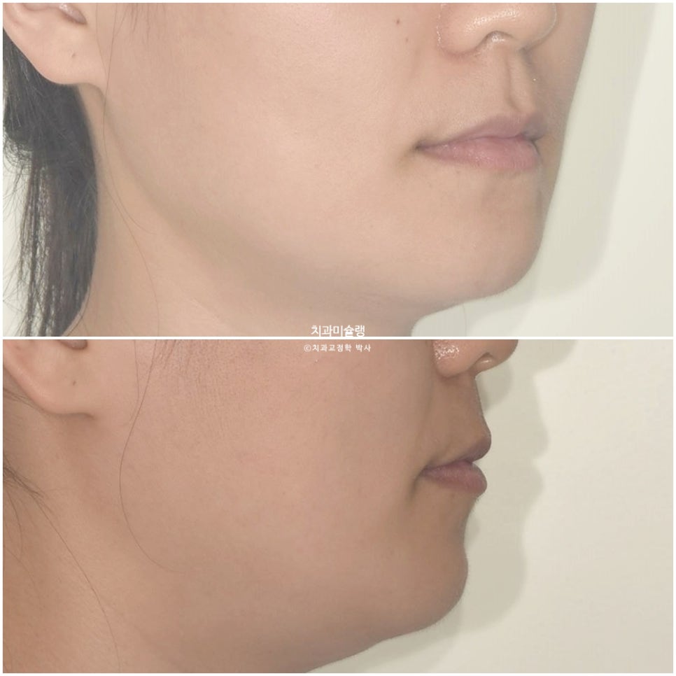 개방교합 덧니 인비절라인 발치 교정 얇은 입술 입매 변화 최소화 교정 치료기간 2년 5개월 재제작 3회