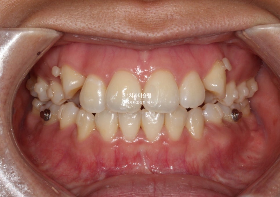 개방교합 덧니 인비절라인 발치 교정 얇은 입술 입매 변화 최소화 교정 치료기간 2년 5개월 재제작 3회