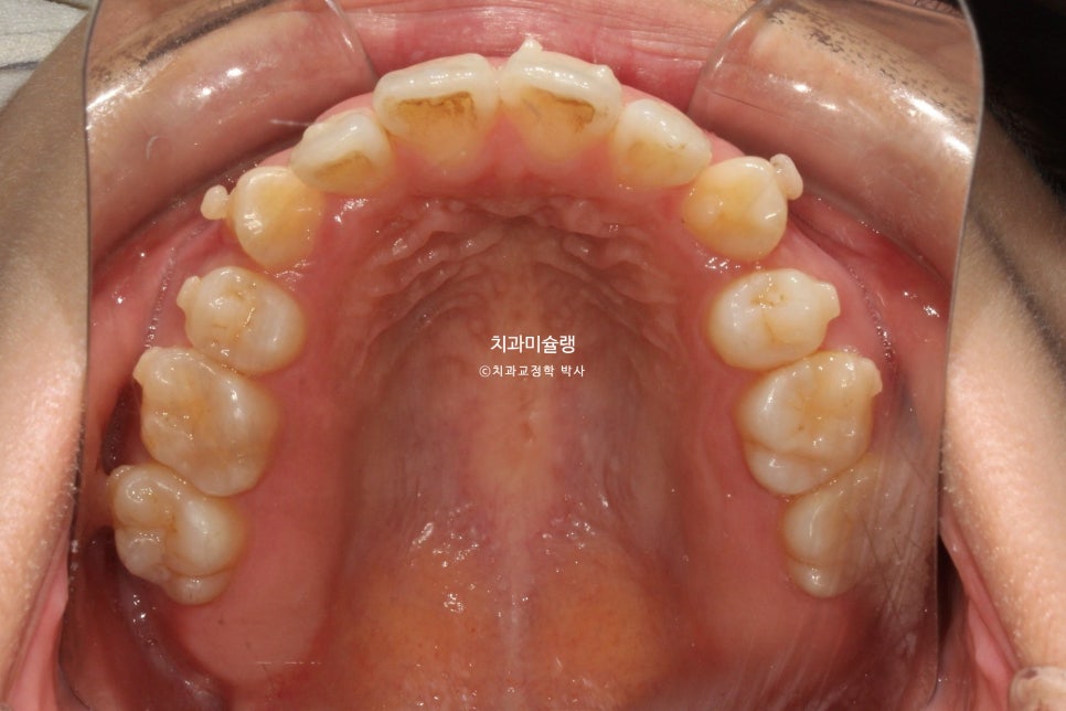 개방교합 덧니 인비절라인 발치 교정 얇은 입술 입매 변화 최소화 교정 치료기간 2년 5개월 재제작 3회