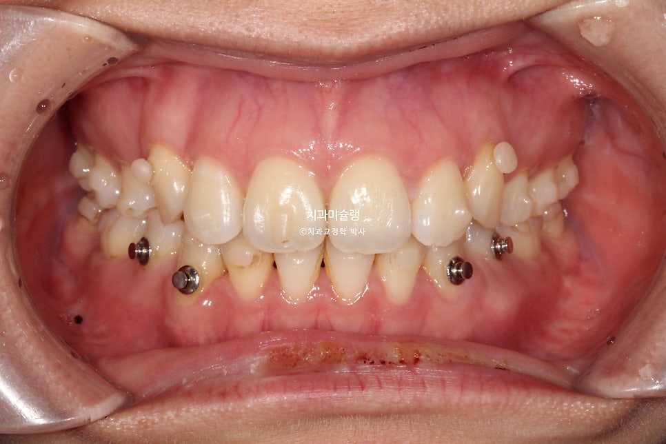 개방교합 덧니 인비절라인 발치 교정 얇은 입술 입매 변화 최소화 교정 치료기간 2년 5개월 재제작 3회