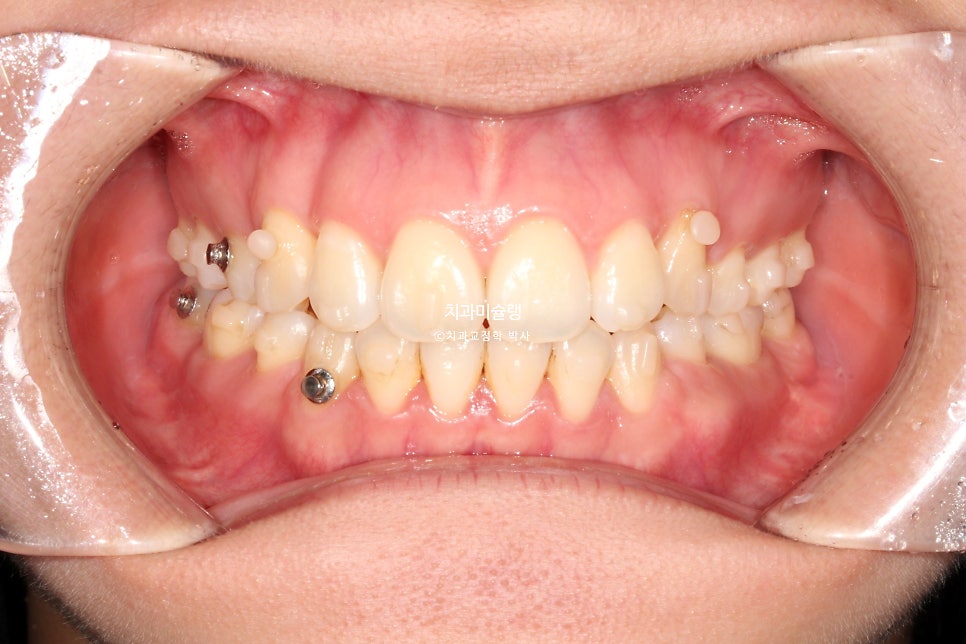 개방교합 덧니 인비절라인 발치 교정 얇은 입술 입매 변화 최소화 교정 치료기간 2년 5개월 재제작 3회