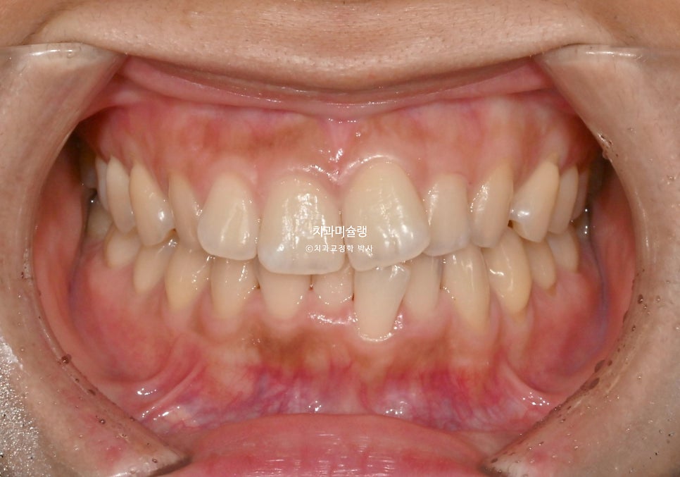 인비절라인 라이트 치축 중심선 블랙트라이앵글 치간삭제 치료기간 8개월 재제작 1회