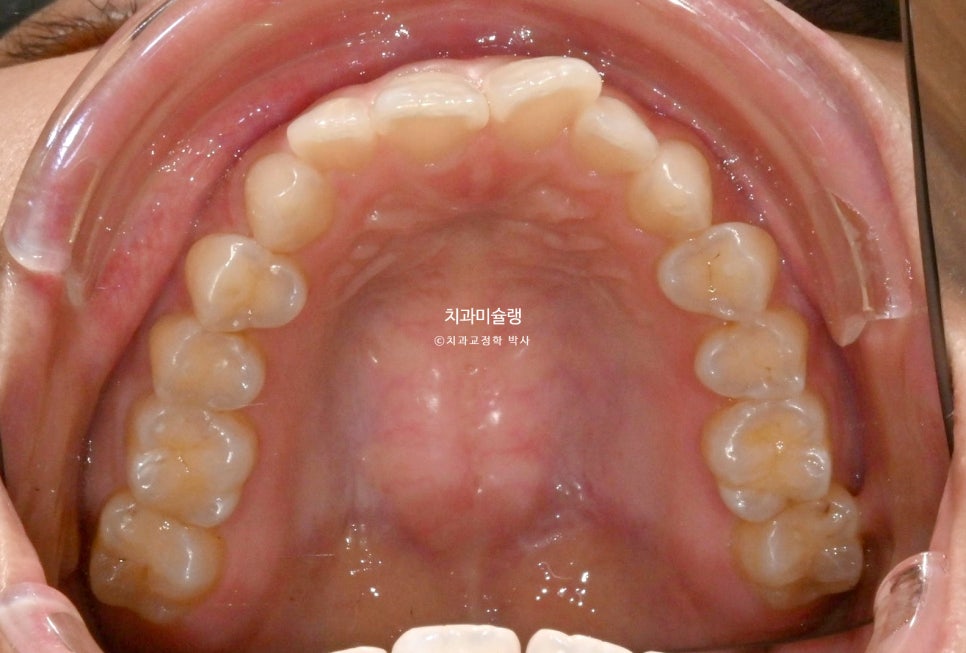 인비절라인 라이트 치축 중심선 블랙트라이앵글 치간삭제 치료기간 8개월 재제작 1회