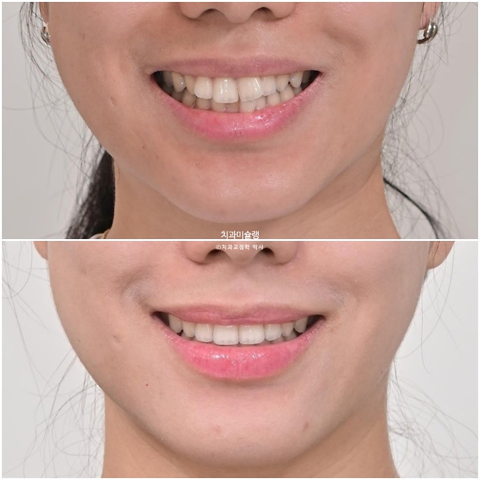 인비절라인 라이트 치축 중심선 블랙트라이앵글 치간삭제 치료기간 8개월 재제작 1회