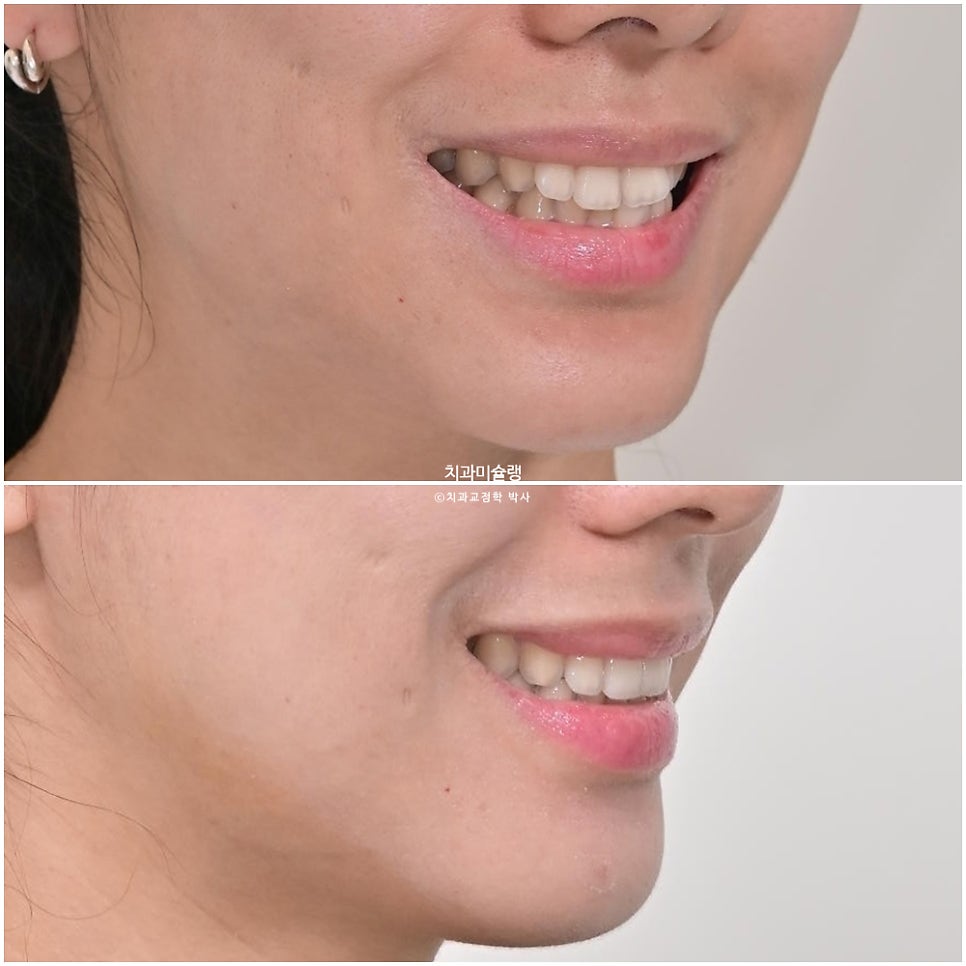 인비절라인 라이트 치축 중심선 블랙트라이앵글 치간삭제 치료기간 8개월 재제작 1회