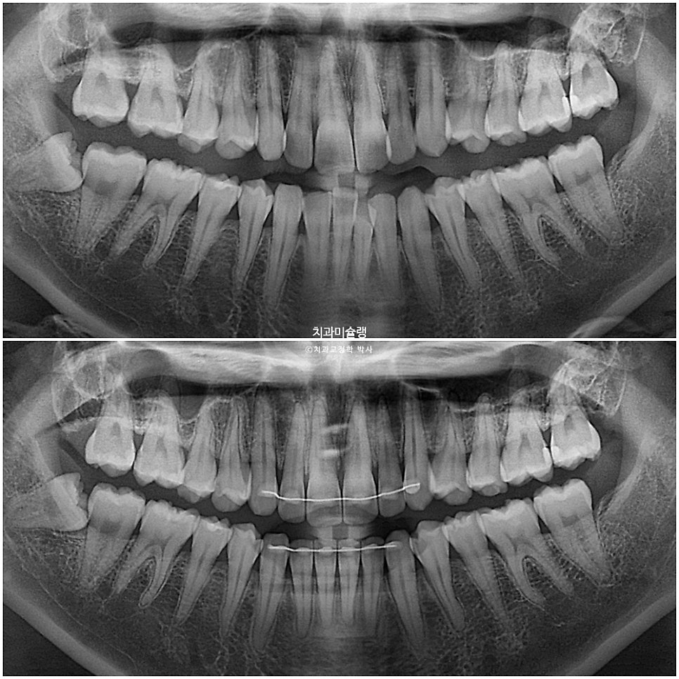 인비절라인 라이트 치축 중심선 블랙트라이앵글 치간삭제 치료기간 8개월 재제작 1회