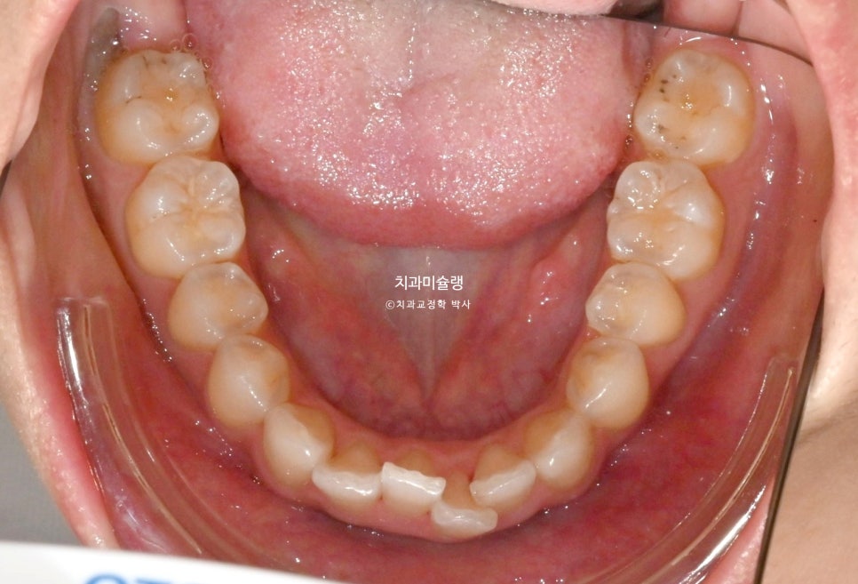 인비절라인 라이트 치축 중심선 블랙트라이앵글 치간삭제 치료기간 8개월 재제작 1회