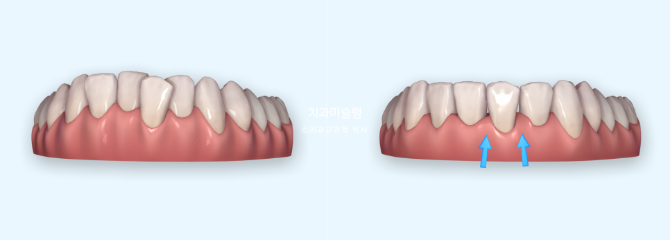 인비절라인 라이트 치축 중심선 블랙트라이앵글 치간삭제 치료기간 8개월 재제작 1회