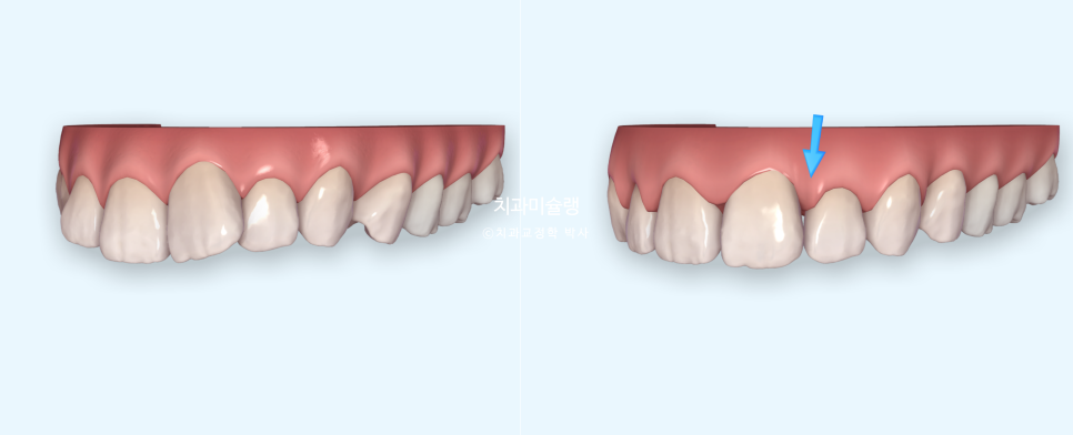 인비절라인 라이트 치축 중심선 블랙트라이앵글 치간삭제 치료기간 8개월 재제작 1회