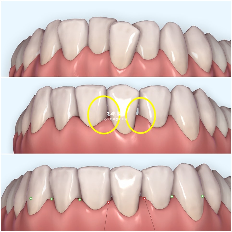 인비절라인 라이트 치축 중심선 블랙트라이앵글 치간삭제 치료기간 8개월 재제작 1회