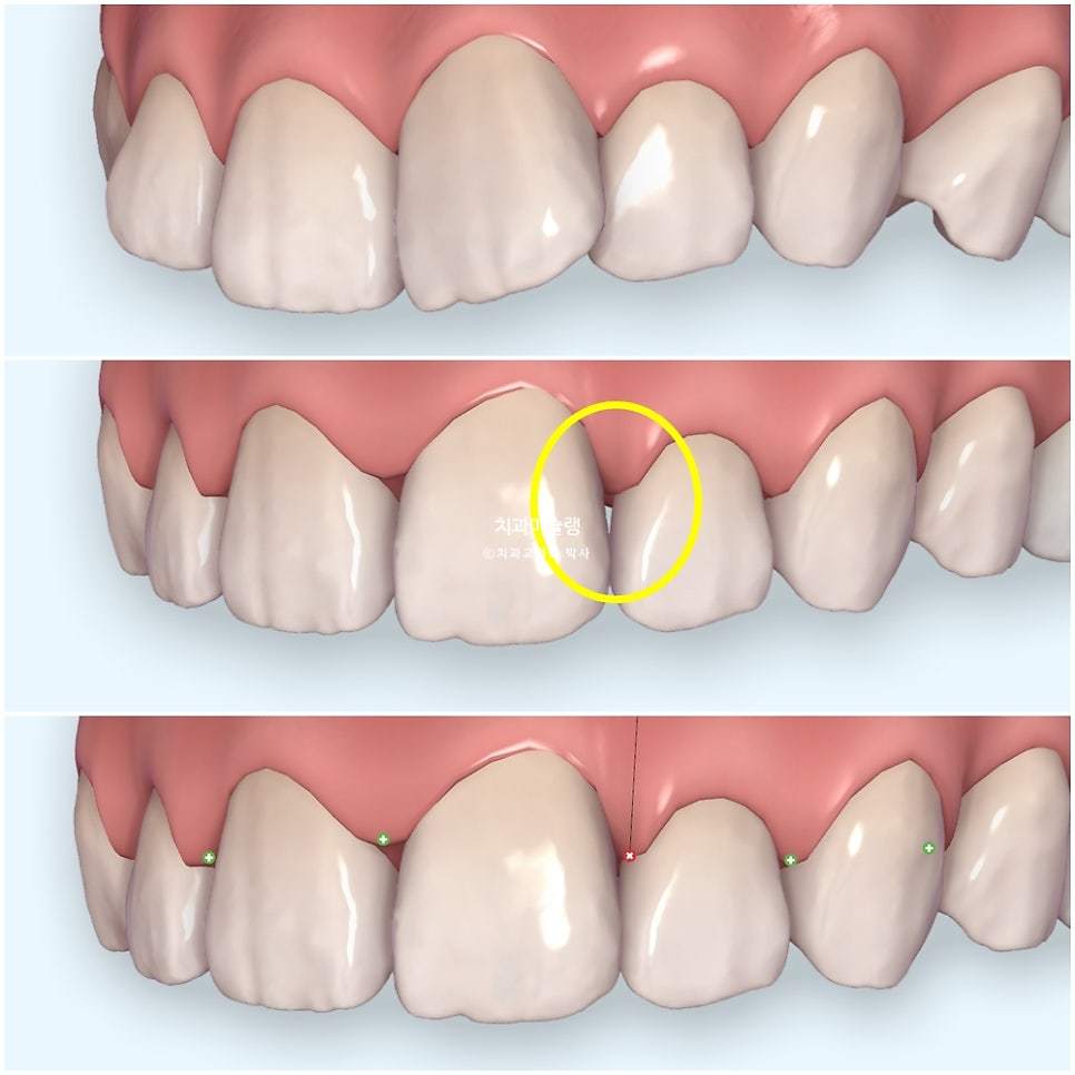 인비절라인 라이트 치축 중심선 블랙트라이앵글 치간삭제 치료기간 8개월 재제작 1회