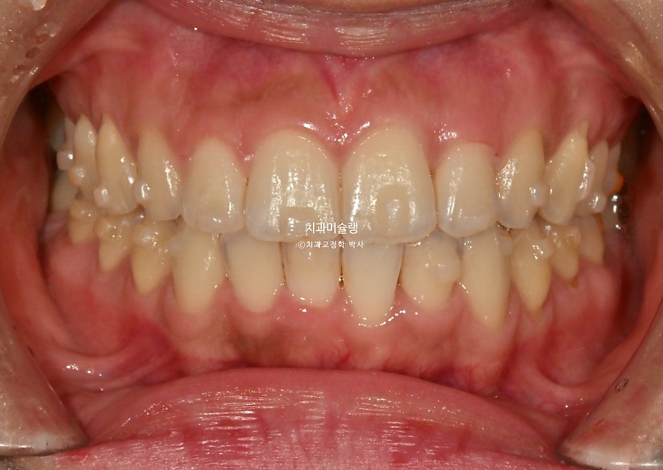 인비절라인 라이트 치축 중심선 블랙트라이앵글 치간삭제 치료기간 8개월 재제작 1회
