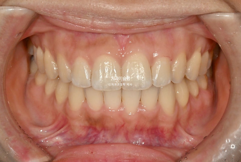 인비절라인 라이트 치축 중심선 블랙트라이앵글 치간삭제 치료기간 8개월 재제작 1회