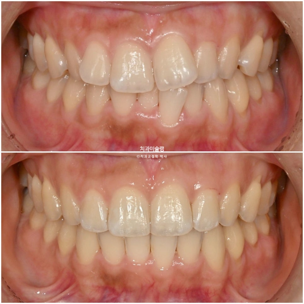인비절라인 라이트 치축 중심선 블랙트라이앵글 치간삭제 치료기간 8개월 재제작 1회