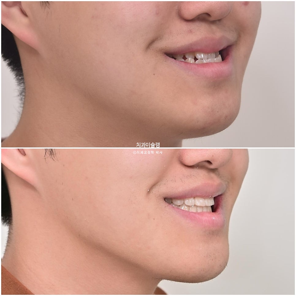 양악수술 없이 주걱턱 3급 부정교합 반대교합 비발치 비수술 절충치료 클리피씨 치료기간 1년11개월