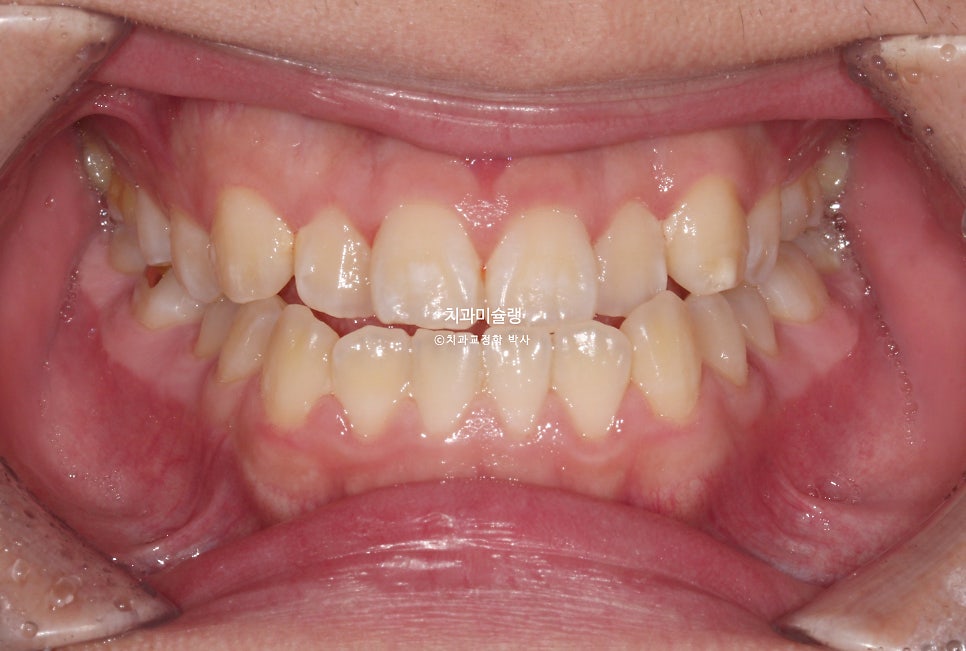 양악수술 없이 주걱턱 3급 부정교합 반대교합 비발치 비수술 절충치료 클리피씨 치료기간 1년11개월